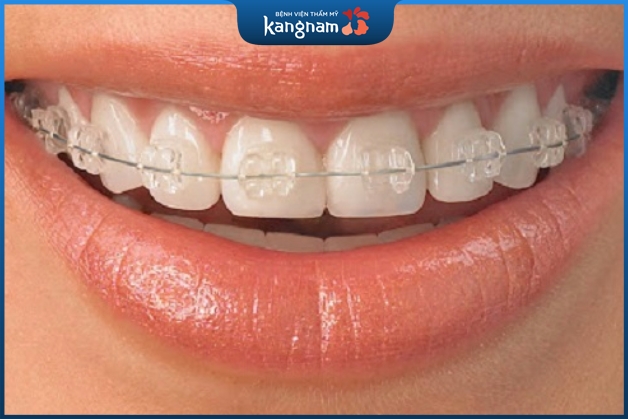 Niềng răng sử dụng mắc cài chất liệu pha lê