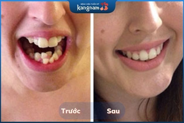 Sở hữu hàm răng đều đẹp và cân đối