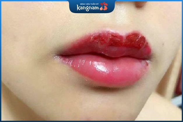 Phun môi bị đau và kích ứng do địa chỉ kém uy tín