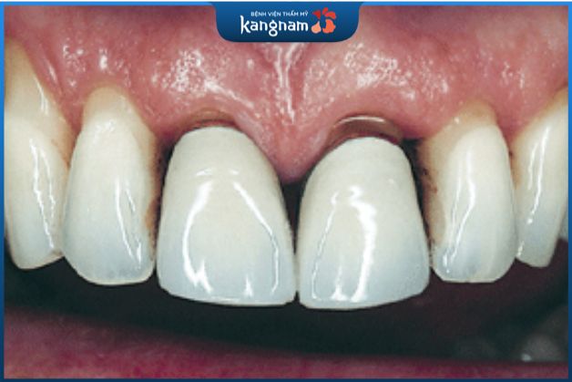 Răng sứ kim loại có tốt không