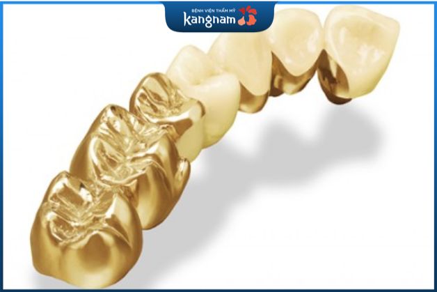 Răng sứ kim loại quý