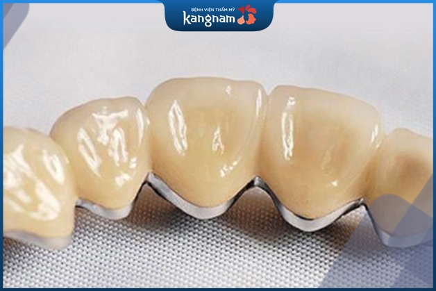 Răng sứ kim loại Titan