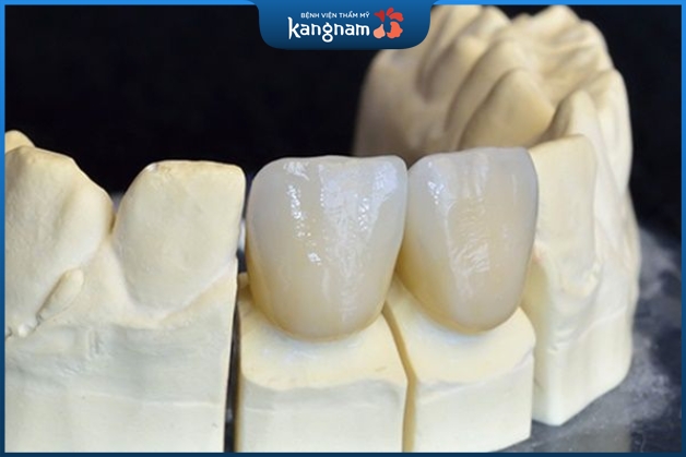 Răng sứ Venus có nhiều loại dựa theo nguồn gốc xuất xứ