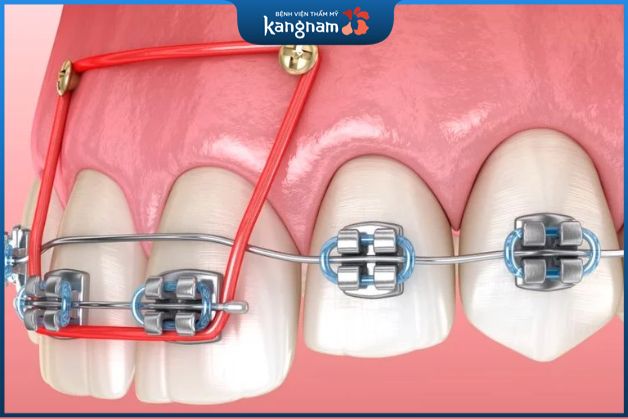 Đánh lún răng mang đến nhiều ưu điểm vượt trội khi niềng răng