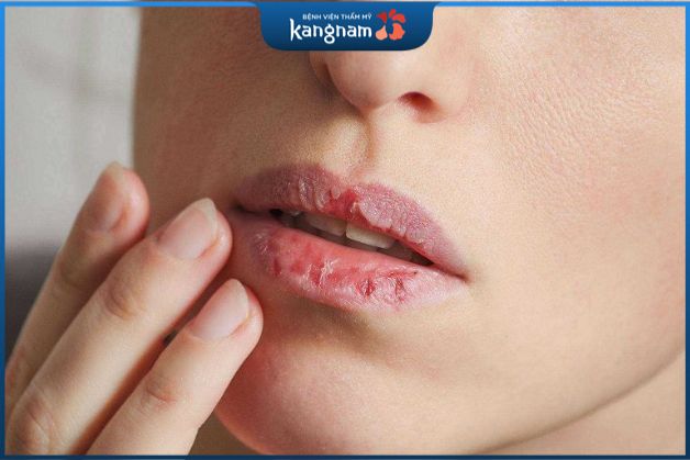 Tăng nguy cơ nhiễm trùng da môi