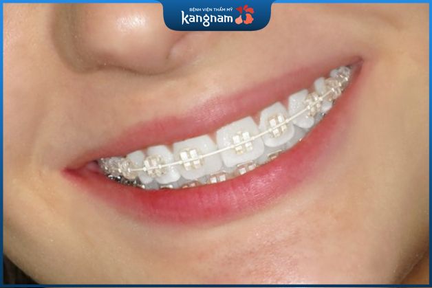Niềng răng mắc cài pha lê tự buộc