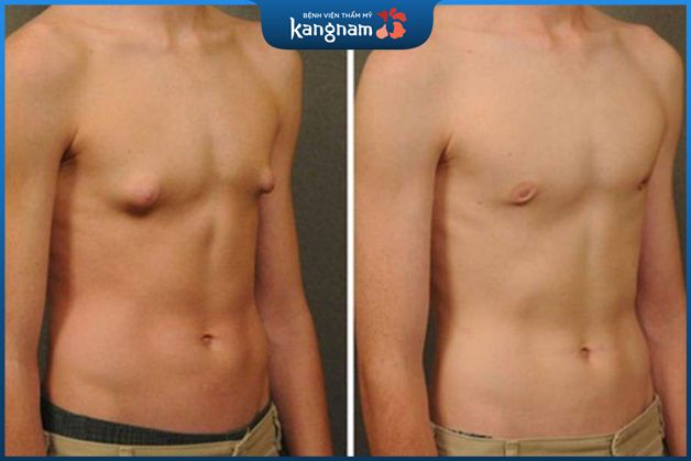 Giảm kích thước vòng 1 bằng thủ thuật thẩm mỹ