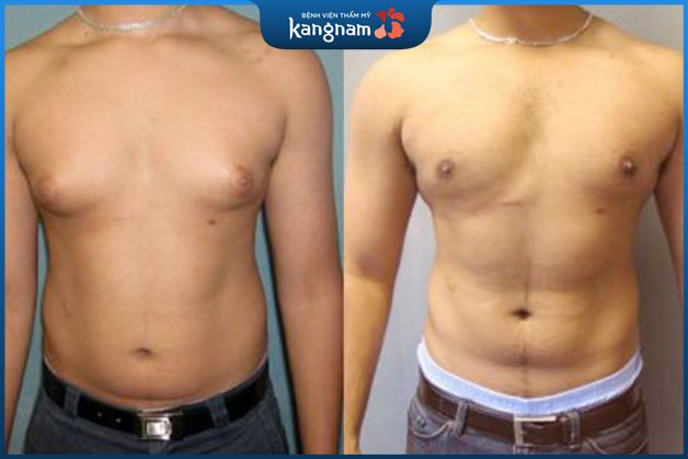 Thu gọn bầu ngực kết hợp làm nhỏ quầng vú nam