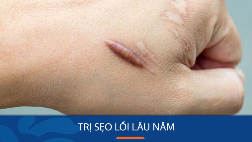 Trị sẹo lồi lâu năm DỨT ĐIỂM bằng công nghệ ELLA tiên tiến