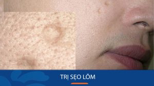 11 Cách trị sẹo lõm tự nhiên hiệu quả tại nhà  không tốn kém