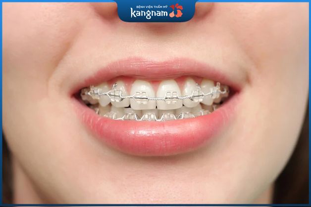 5 Ưu điểm vượt trội của mắc cài pha lê