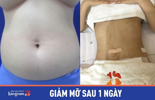 Mỡ bụng dưới được loại bỏ hoàn toàn