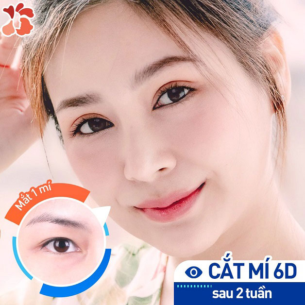 Cắt mí hồi phục nhanh, không lộ sẹo