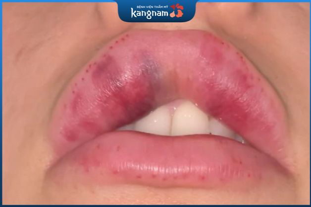Dấu hiệu tiêm filler môi bị hoại tử