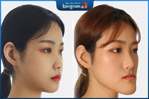 Độn cằm xong bị móm hàm do công nghệ cũ