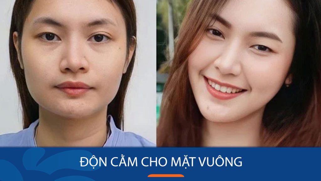 Độn cằm cho mặt vuông có phù hợp không? Hiệu quả & những điều cần biết