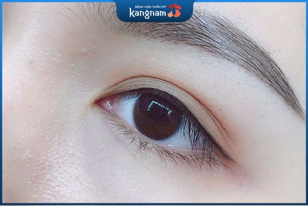 Phun mí mở tròng mang đến đường mí đẹp tự nhiên