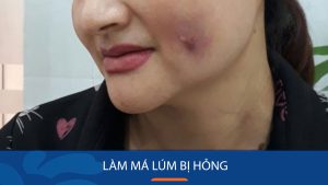 Biểu Hiện và Cách Xử Lý Khi Làm Má Lúm Bị Hỏng – Lưu Ý Chăm Sóc