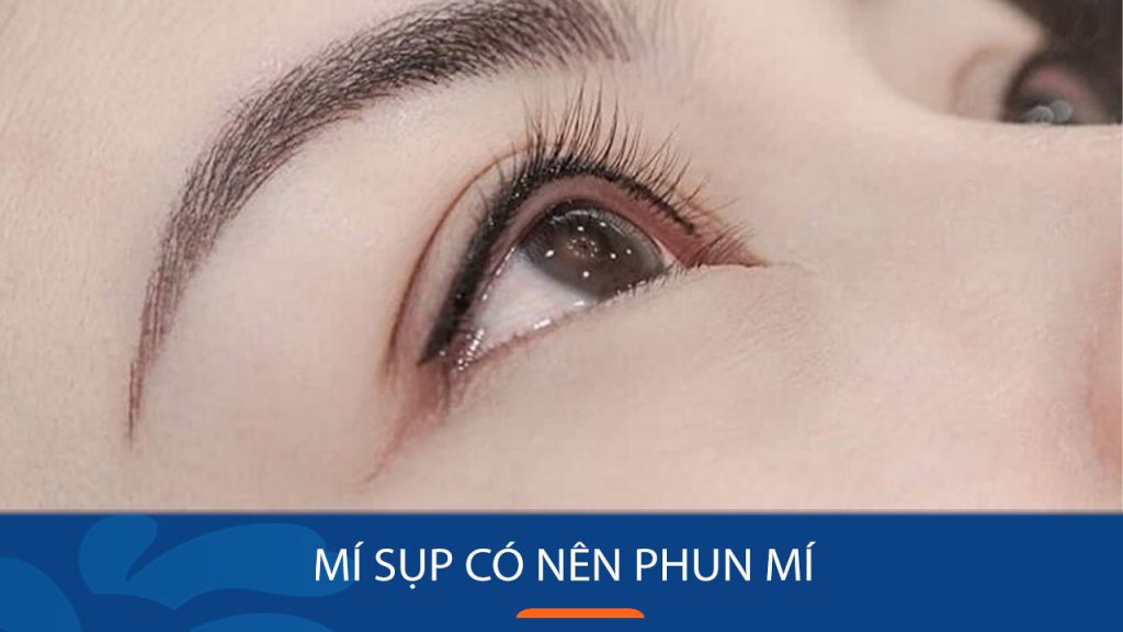 Mí sụp có nên phun mí không? Khắc phục mí sụp hiệu quả