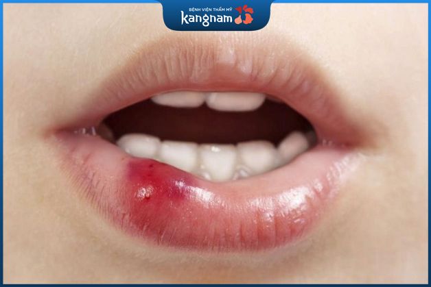 Môi bị sưng đau có thể do filler kém chất lượng