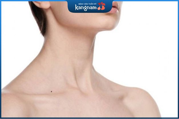 Nốt ruồi ở hõm cổ