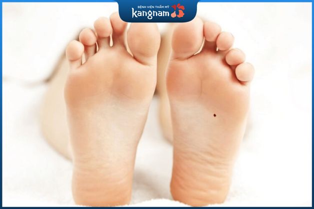 Nốt ruồi ở lòng bàn chân tượng trưng cho sự nghiệp thành công