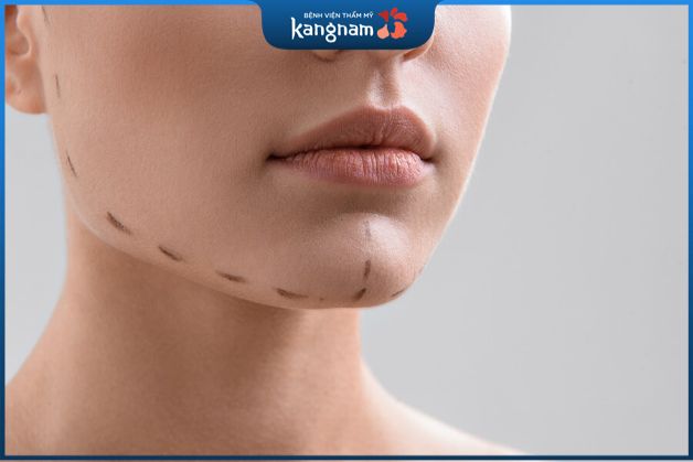 Độn cằm cho mặt vuông