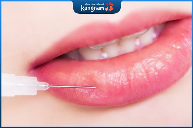 Tiêm môi xong bị đau là do cơ địa