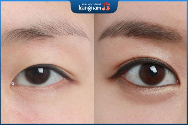 Phun mí Mang đến kết quả thẩm mỹ hoàn hảo, khắc phục tốt tình trạng mí sụp