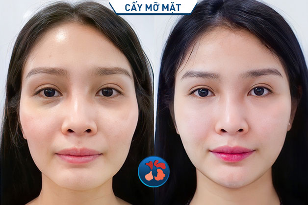 Làm đầy thái dương bằng mỡ tự thân kết hợp cấy mỡ mặt giúp khách hàng trẻ ra 10 tuổi