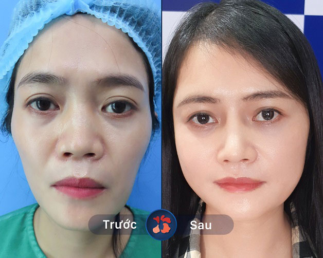 Làm đầy thái dương khắc phục tình trạng gò má cao, mặt hóp già nua