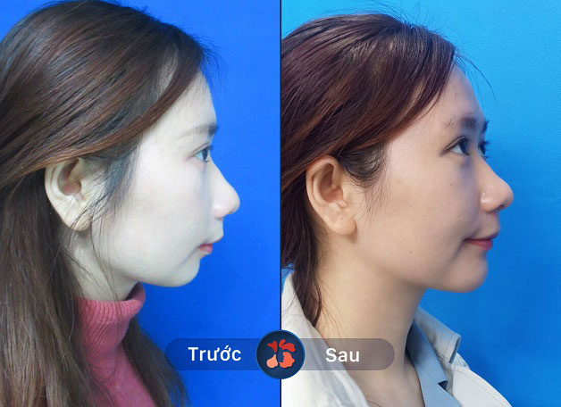 Cằm lẹm khiến góc nghiêng thiếu thẩm mỹ, độn cằm có thể khắc phục hoàn hảo