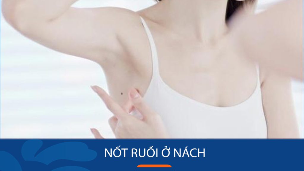 Nốt ruồi ở nách: Tốt hay xấu? Giải mã bí ẩn & Cách xử lý