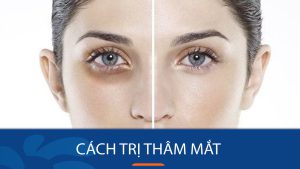 10 Cách trị thâm mắt hiệu quả – “Xóa sổ” quầng thâm