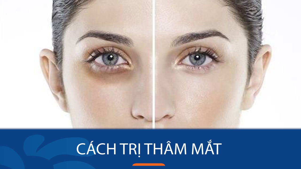 10 Cách trị thâm mắt hiệu quả – “Xóa sổ” quầng thâm