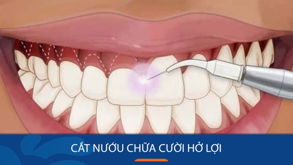 Cắt nướu chữa cười hở lợi: Tất cả những điều bạn cần biết