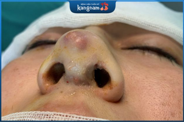 Nhìn thấy sụn nâng ở đầu mũi có nếp hằn