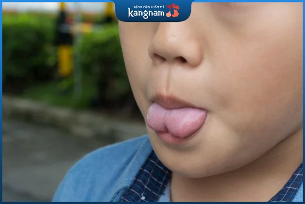 Hình dáng lưỡi khi thè ra rất xấu do dính dây thắng lưỡi