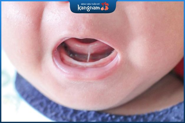 Dính thắng lưỡi