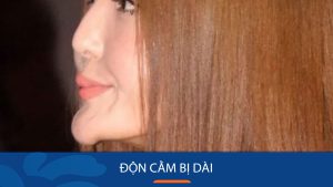 Cứu cánh cho cằm bị dài sau khi độn: Các phương pháp khắc phục hiệu quả