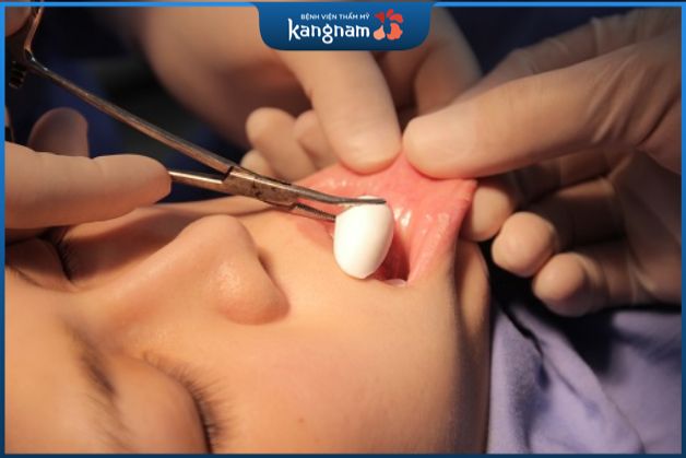 Mặt dài có nên độn cằm