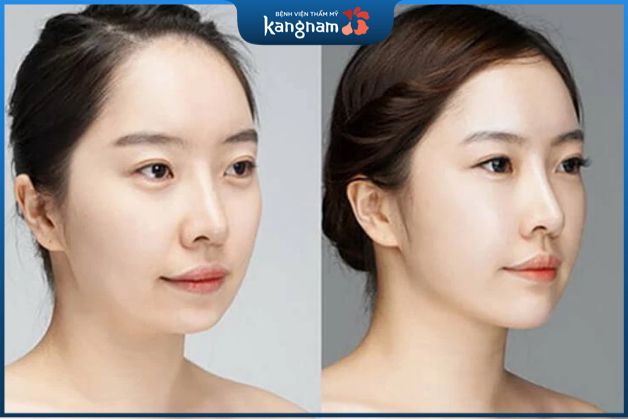 Độn cằm phù hợp với những người cằm vuông, cằm lẹm, cằm ngắn, ...