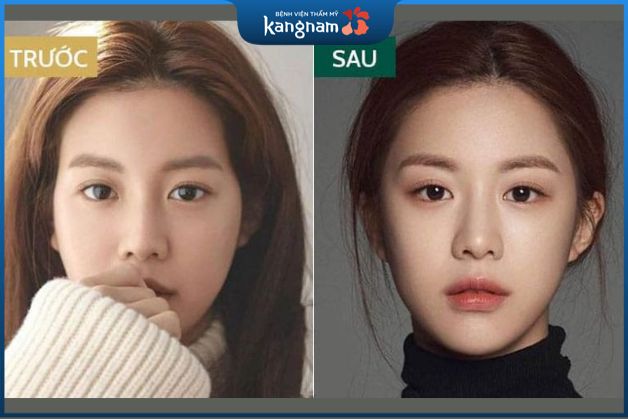 Độn thái dương duy trì bao lâu còn tùy vào tình trạng mỗi người