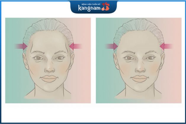 Độn thái dương là phương pháp làm đẹp giúp khắc phục vùng thái dương bị hóp