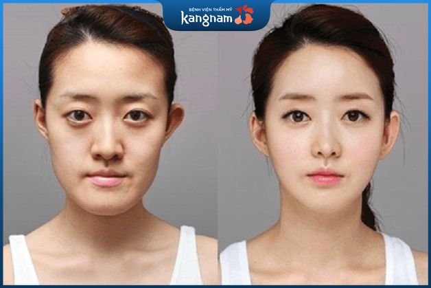 Làm gọn mặt không qua phẫu thuật phù hợp với ai?