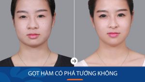 Gọt hàm có phá tướng không? Giải đáp theo phong thủy và góc nhìn y khoa