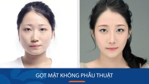 Gọt mặt không phẫu thuật là gì? Các phương pháp thu gọn mặt và lưu ý quan trọng