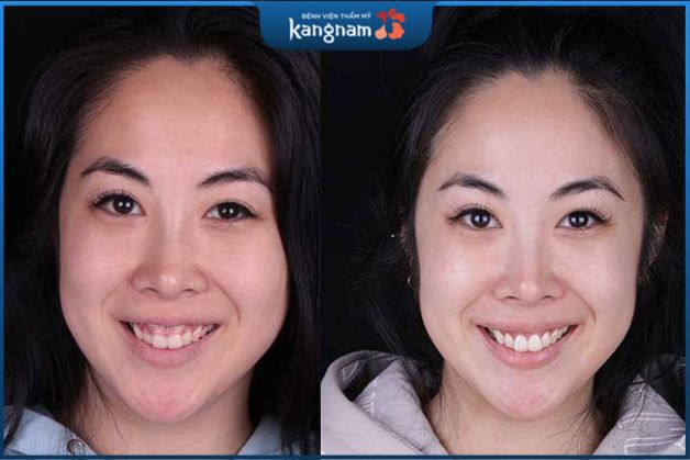 Thành quả khách hàng cắt nướu tại Kangnam