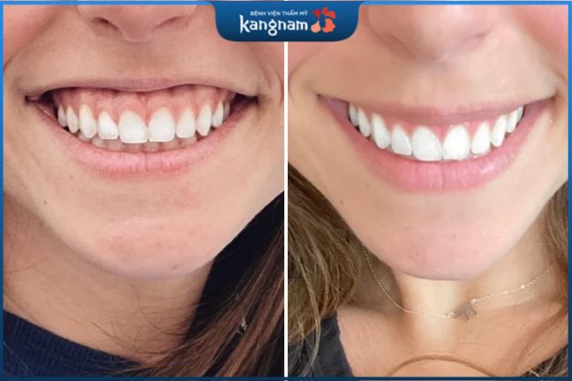 Khắc phục cười hở lợi nhanh chóng và an toàn