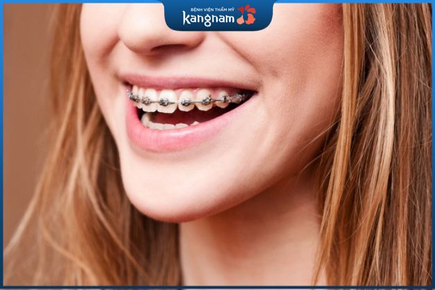 Tìm hiểu trước về phác đồ niềng răng của bác sĩ nha khoa